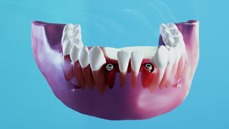 Ceramic-dental-implantation-process